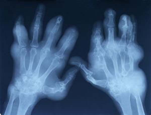X-ray of an elderly patient with extremely swollen hands from arthiritis